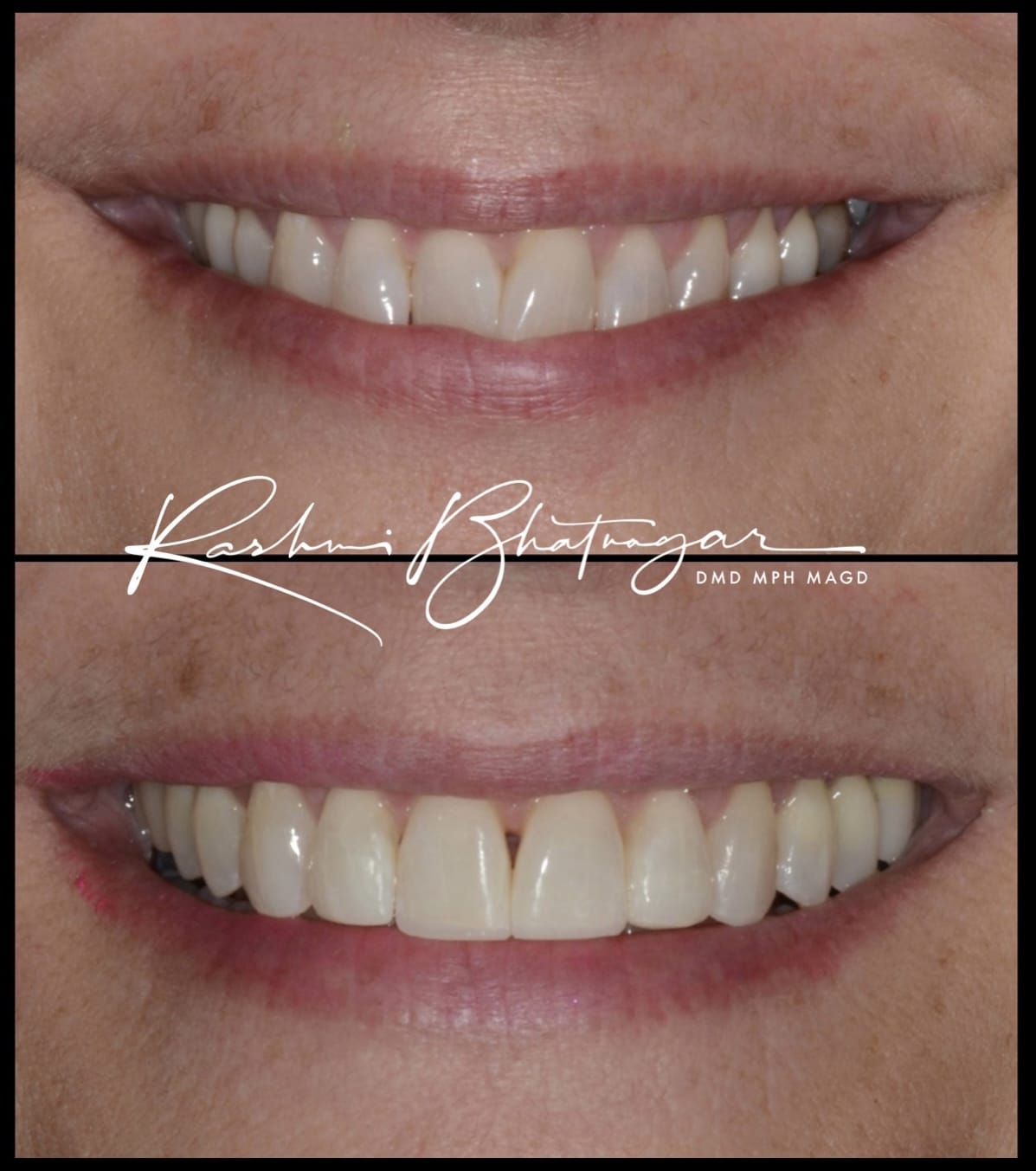 Veneer cosmetic treatment before and after