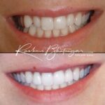 veneers