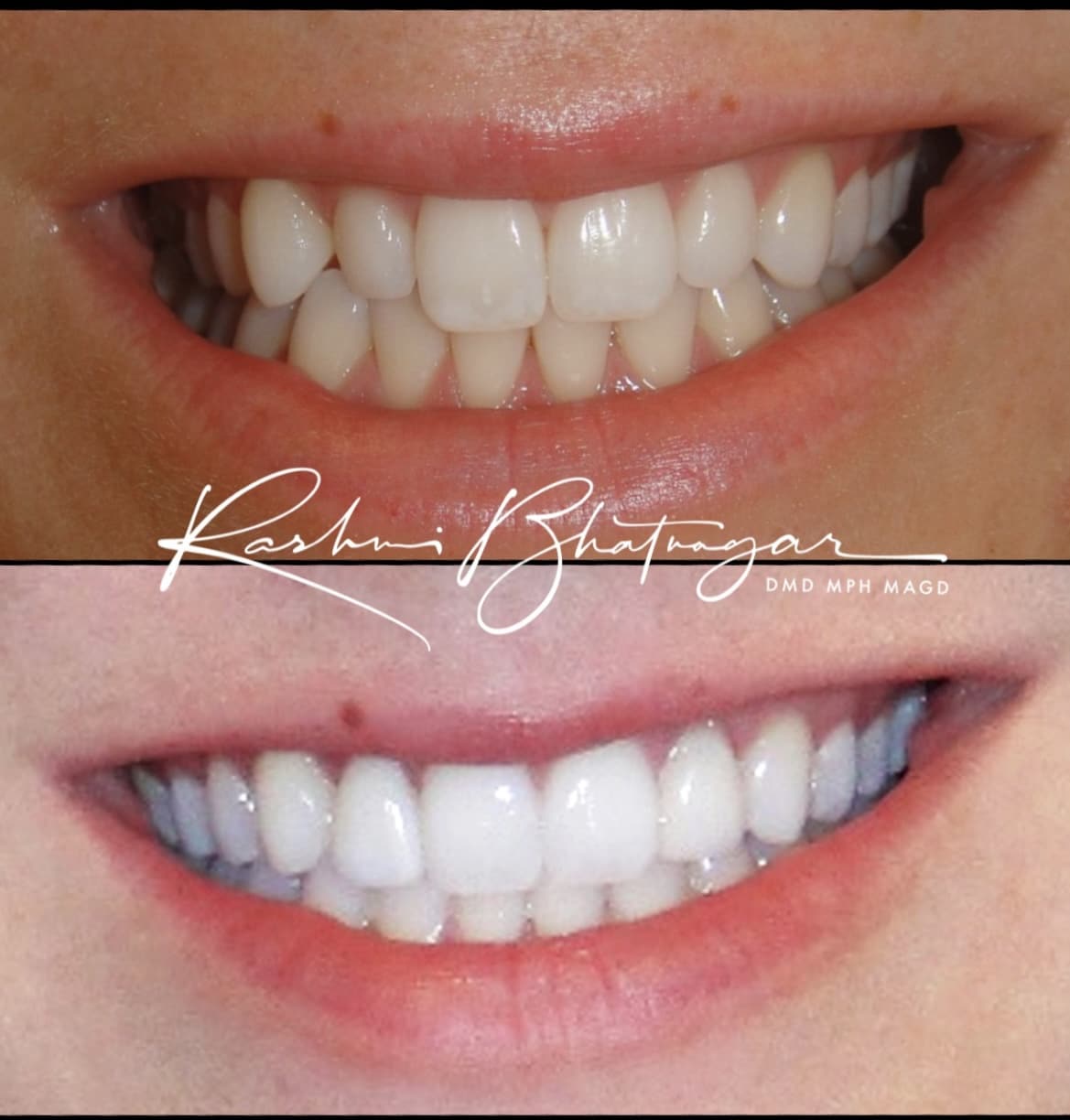 dental ceramic crowns treatment before and after