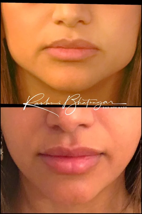 lip filler before and after smile