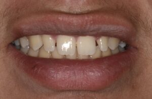 A close up of a man's mouth with white teeth. and small gaps