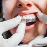 Doctor putting a clear dental aligner to the patient woman - Bella Vista Dental Care