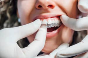 Doctor putting a clear dental aligner to the patient woman - Bella Vista Dental Care