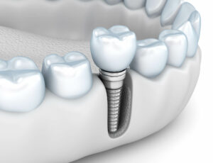 single dental implant placement