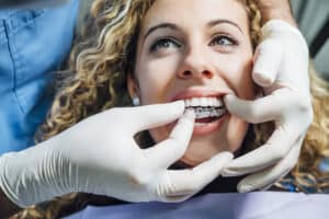 Doctor putting a clear dental aligner to the patient woman