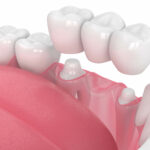 cerec crown