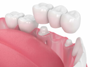 cerec crown