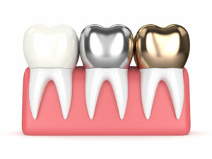 cerec crown vs traditional