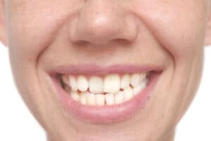 Invisalign is for you if you have crooked teeth