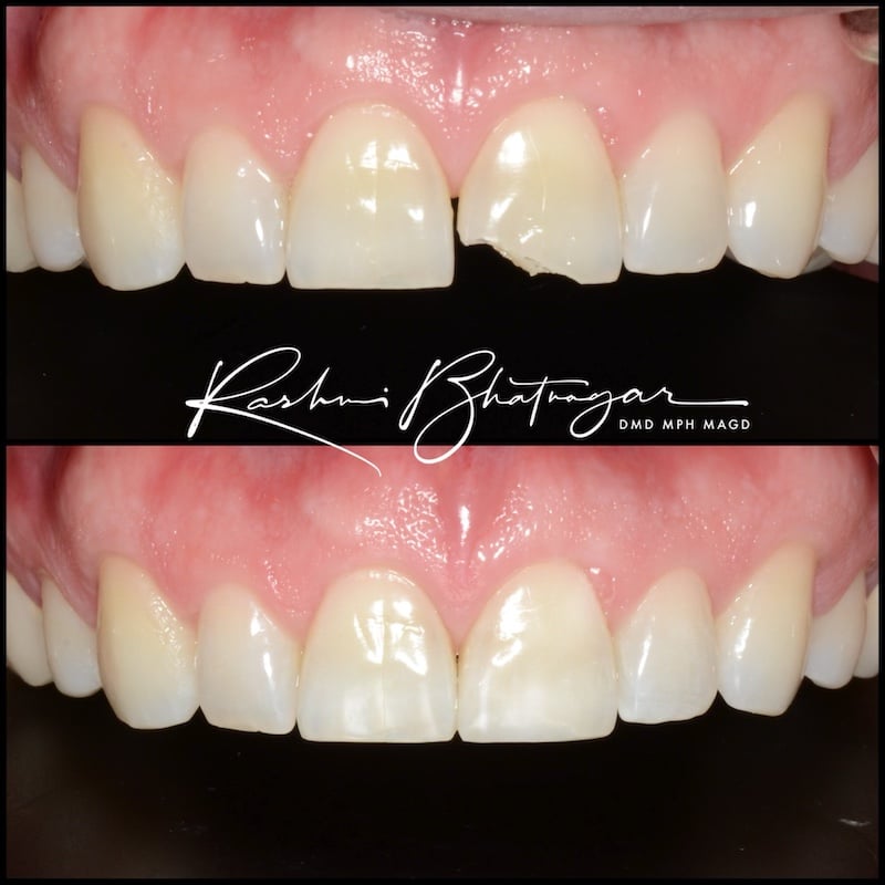 before and after image of a dental bonding in a chipped tooth