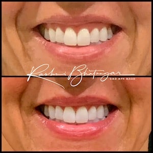 smile line botox before and after