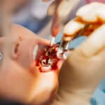 Extraction of Wisdom Teeth-BellaVista DentalCare