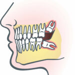 illustration of impacted teeth