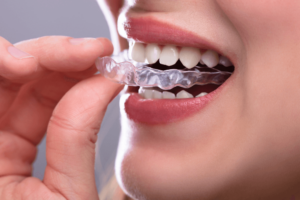 Invisalign Treatment