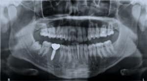 dental implant xray